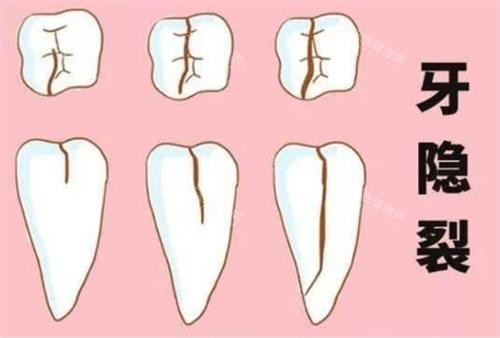 牙齿裂纹的程度