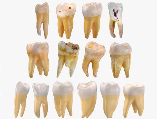 牙齿龋坏磨损 牙齿龋坏磨损