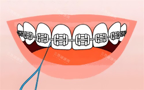 金属牙齿矫正卡通图片