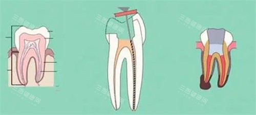牙齿受损 牙齿受损