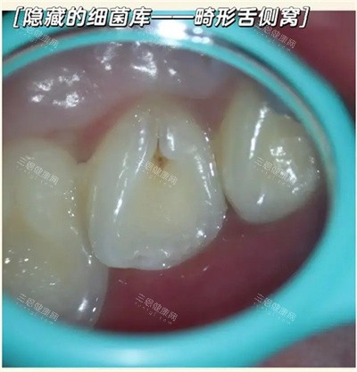 畸形舌侧窝牙齿展示图 畸形舌侧窝牙齿展示图