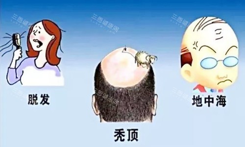 脱发图示 脱发图示