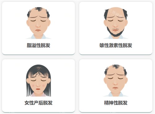 不同脱发类型 不同脱发类型