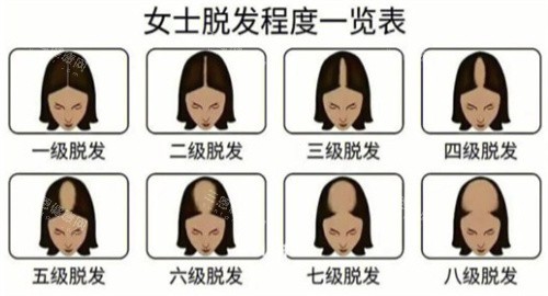 脱发等级 脱发等级