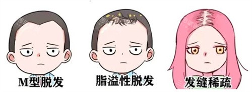 脱发种类 脱发种类