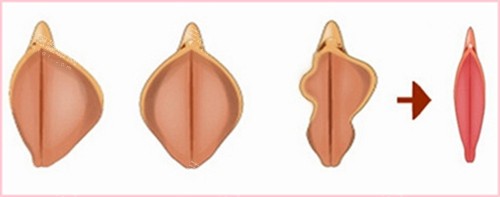 阴唇肥大和理想阴唇对比动画图 阴唇肥大和理想阴唇对比动画图
