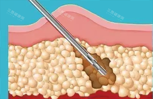 吸脂手术剖面演示图 吸脂手术剖面演示图