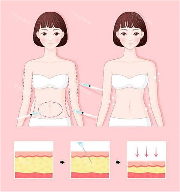 腰腹吸脂对比 腰腹吸脂对比