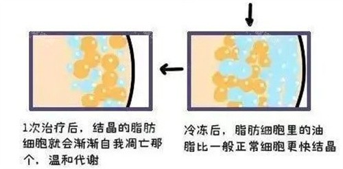 酷塑吸脂原理 酷塑吸脂原理