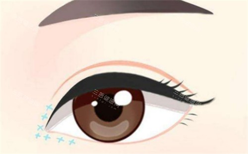 眼综合手术后眼部的样子