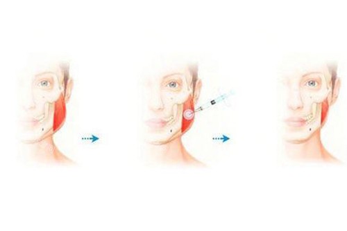 注射瘦脸示意图2 注射瘦脸示意图2
