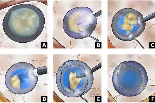 超声乳白内障手术 超声乳白内障手术