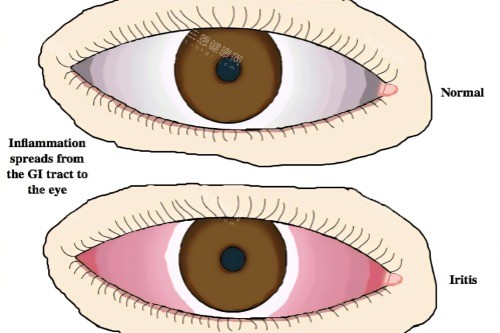 虹膜炎与健康眼睛对比 虹膜炎与健康眼睛对比