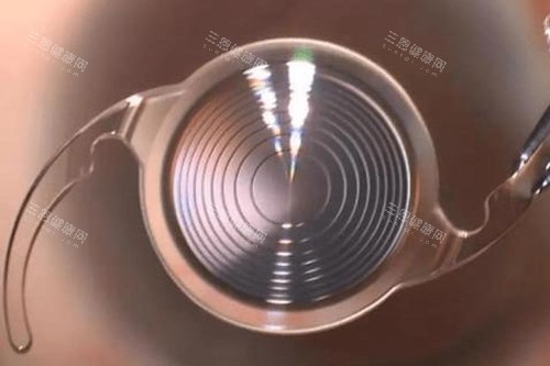 白内障晶体图片 白内障晶体图片