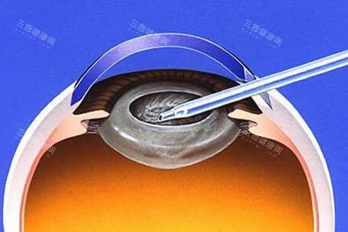 白内障手术卡通图 白内障手术卡通图