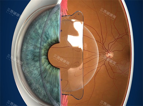 进行晶体植入的眼睛 进行晶体植入的眼睛