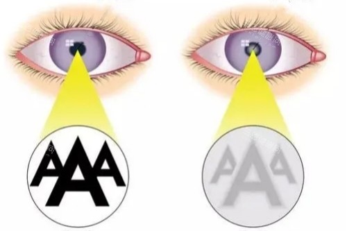 白内障与正常眼睛视物卡通图 白内障与正常眼睛视物卡通图