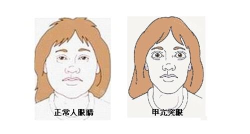正常眼睛和突眼的对比 正常眼睛和突眼的对比