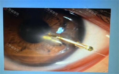 眼睛白斑治疗 眼睛白斑治疗