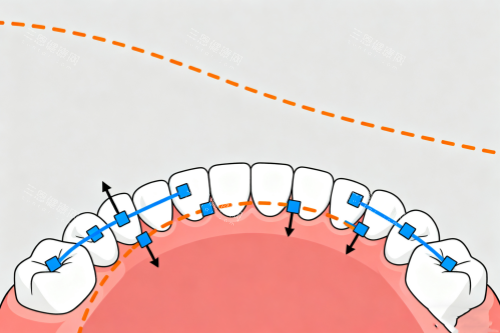 牙齿矫正概念图