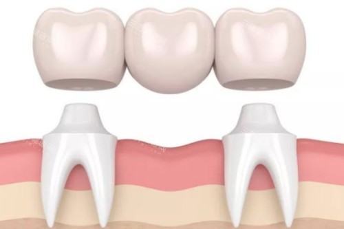 镶牙卡通展示图 镶牙卡通展示图