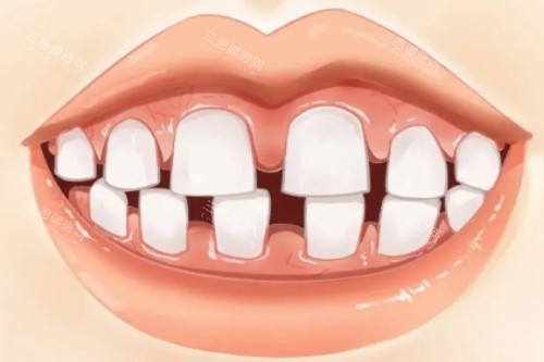 牙齿牙缝大 牙齿牙缝大