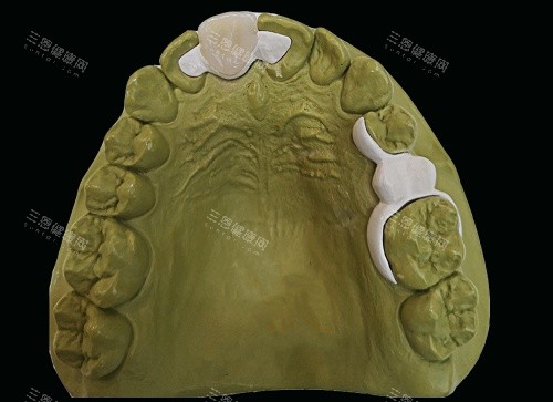 hpp粘接桥牙齿口腔内示意图 hpp粘接桥牙齿口腔内示意图