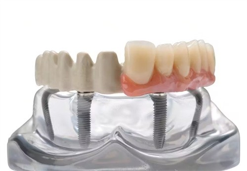 peek支架半口修复义齿 peek支架半口修复义齿