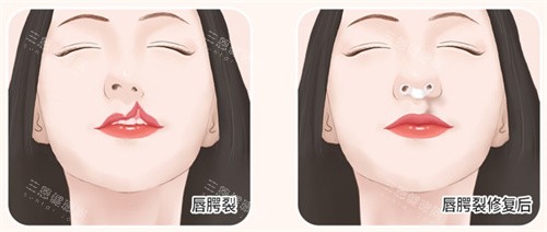 唇腭裂修复 唇腭裂修复