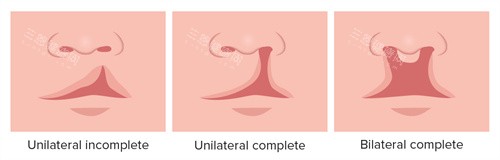 唇裂和唇腭裂不同程度 唇裂和唇腭裂不同程度