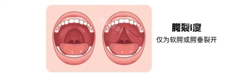 一度唇腭裂 一度唇腭裂