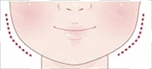 适合打玻尿酸面部轮廓 适合打玻尿酸面部轮廓