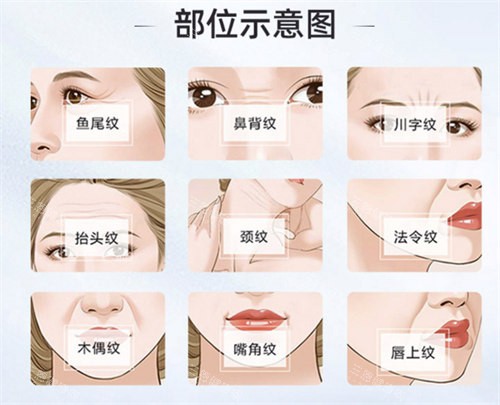 面部除皱部位演示动画图 面部除皱部位演示动画图
