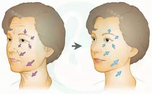 面部除皱对比图 面部除皱对比图