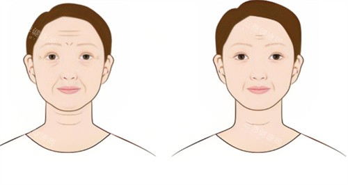 面部除皱术 面部除皱术