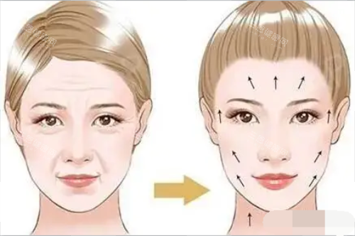 面部除皱对比图 面部除皱对比图