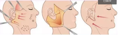 手术除皱示意图 手术除皱示意图