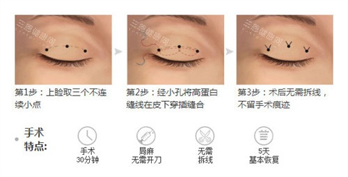 长春割双眼皮医生推荐！中妍整形哪位医生技术好？真实病例对比分析！