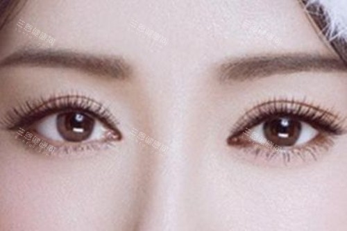 割双眼皮 割双眼皮