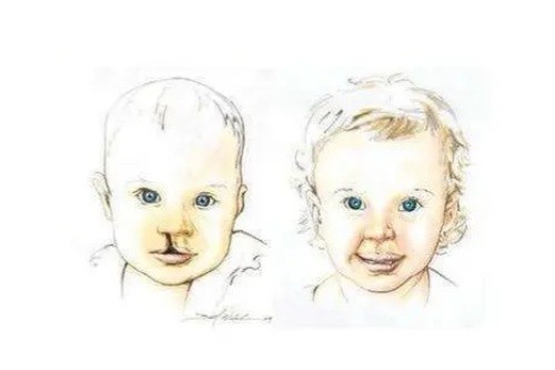 唇腭裂修复对比图 唇腭裂修复对比图