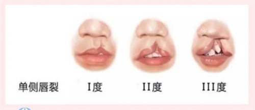 不同的唇腭裂 不同的唇腭裂