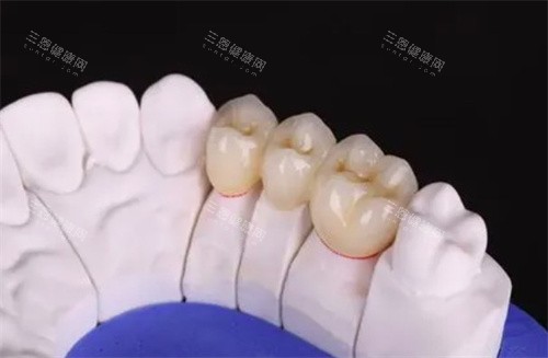 爱尔创全瓷牙 爱尔创全瓷牙