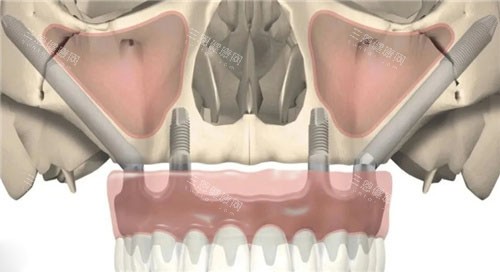 穿颧穿翼种植正面图
