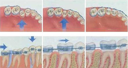 牙齿矫正移动过程示意图 牙齿矫正移动过程示意图