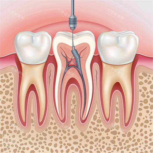 牙齿根管治疗牙髓问题漫画图 牙齿根管治疗牙髓问题漫画图
