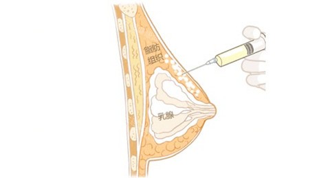 自体脂肪隆胸通图 自体脂肪隆胸通图