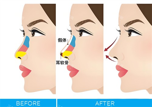 隆鼻手术图解动画图 隆鼻手术图解动画图