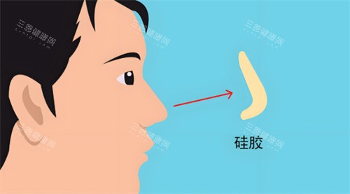 硅胶假体隆鼻 硅胶假体隆鼻