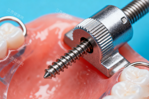 牙齿保持器安装图片展示