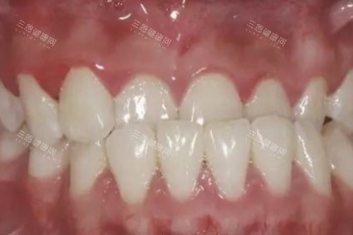 牙齿地包天卡通图